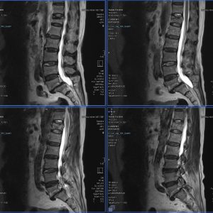 Chấn thương cột sống
