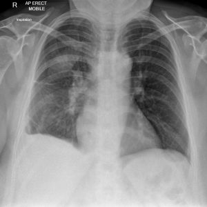 Tràn dịch màng phổi