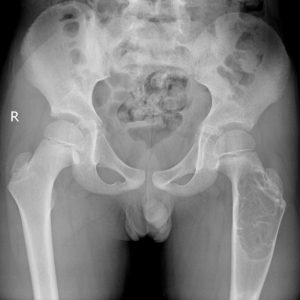 Nang xương phình mạch