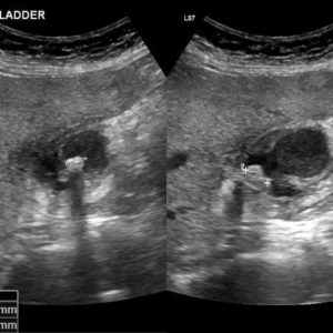 Viêm túi mật cấp