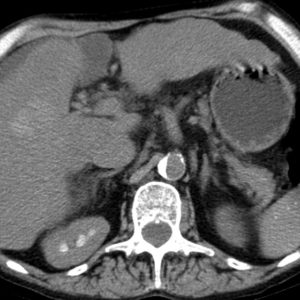 HCC / Gan nhiễm mỡ