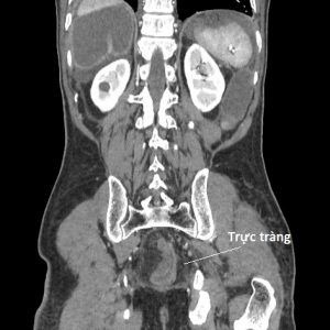 Xoắn đại tràng Sigma