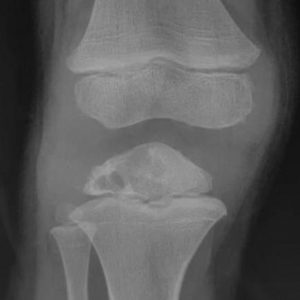 U nguyên bào sụn