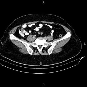 U nhầy ruột thừa