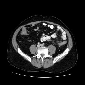 Thủng tạng rỗng