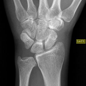 Chấn thương cổ tay