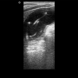 Giun đường mật