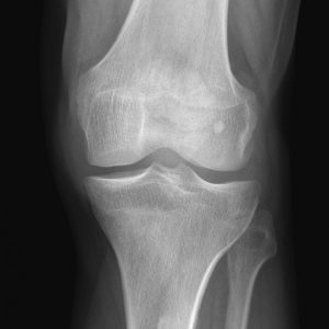 Chấn thương khớp gối