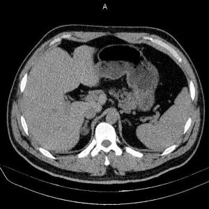 U tuyến thượng thận
