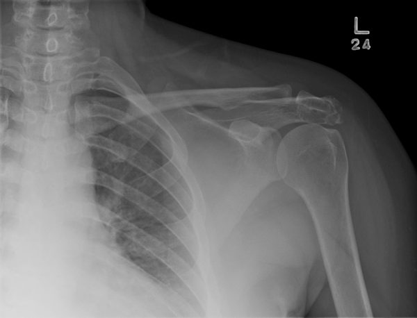 Sarcoma sụn