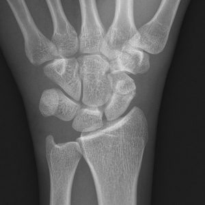 Chấn thương cổ tay