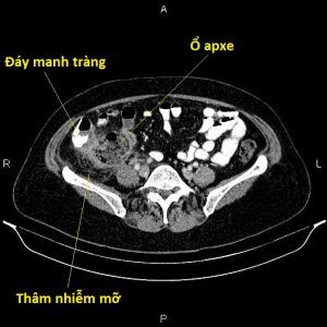 Apxe ruột thừa