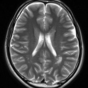 Rộng khoang quanh mạch