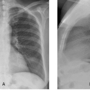 Thoát vị hoành