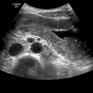 Viêm loét dạ dày