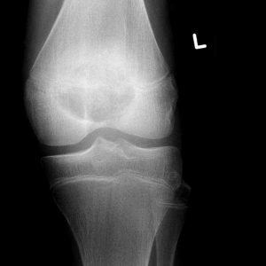 U nguyên bào sụn