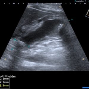 Viêm túi mật cấp