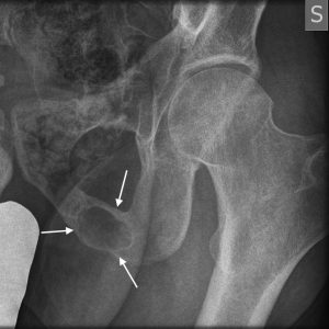 U nguyên bào sụn