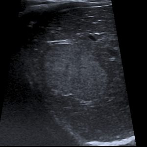 Tăng sản nốt khu trú