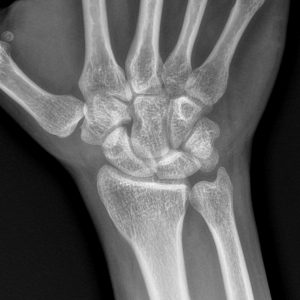 Chấn thương cổ tay