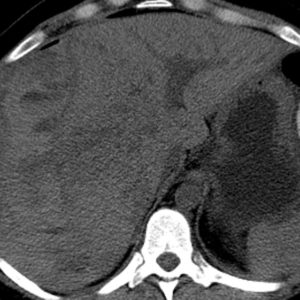 Tụ máu dưới bao gan