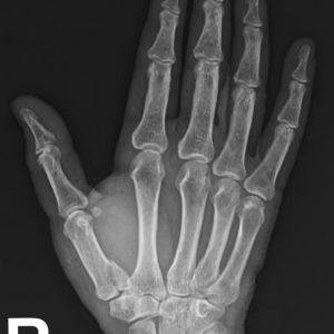 Gãy xương bàn tay