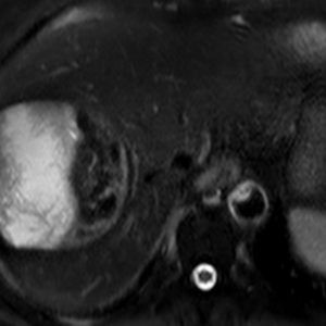 Tụ máu dưới bao gan