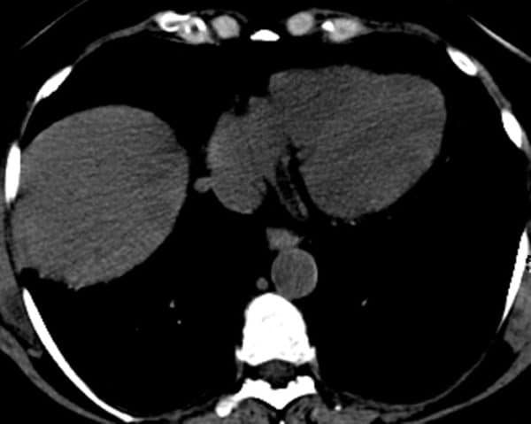 Lymphoma gan