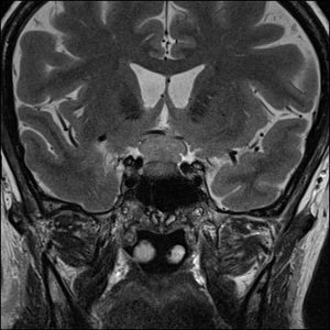 Di căn tuyến yên