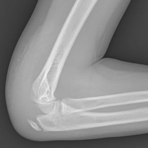 Chấn thương khuỷu tay