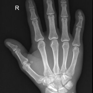 Gãy xương bàn tay