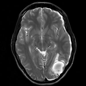 Chấn thương sọ não