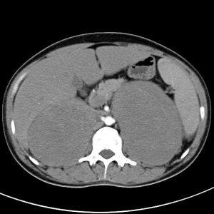 Lymphoma tuyến thượng thận 2 bên