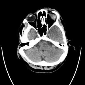 Chấn thương nhãn cầu