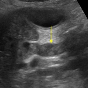 Bùn đường mật