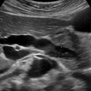 Bùn đường mật