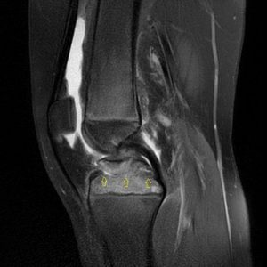 PD fatsat: bong điểm bám dây chằng chéo trước