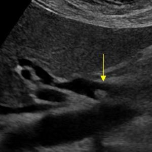 Sỏi ống mật chủ