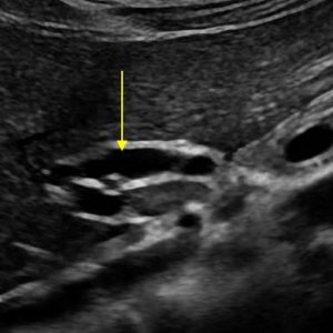 Sỏi đường mật
