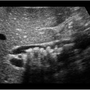 Sỏi đường mật