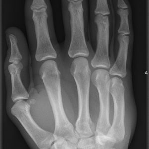 Chấn thương bàn tay