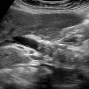 Sỏi bùn đường mật