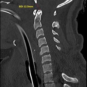 Chấn thương cột sống