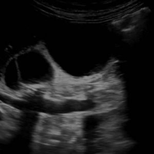 Sỏi đường mật