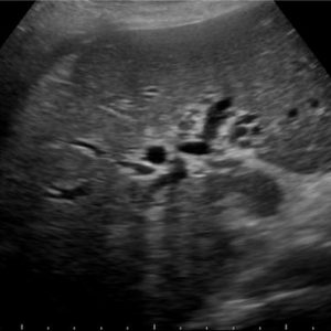 Sỏi đường mật