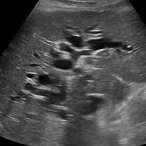 Sỏi đường mật