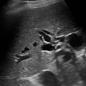 Sỏi đường mật