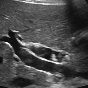 Sỏi đường mật