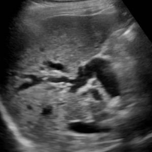 Sỏi đường mật