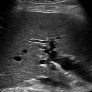 Sỏi đường mật